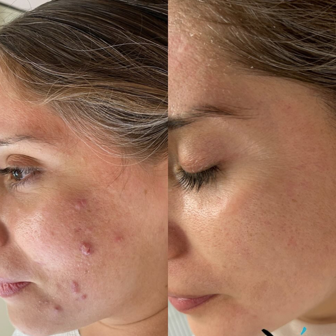 Sensitive Spot Cream