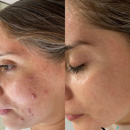 Sensitive Spot Cream