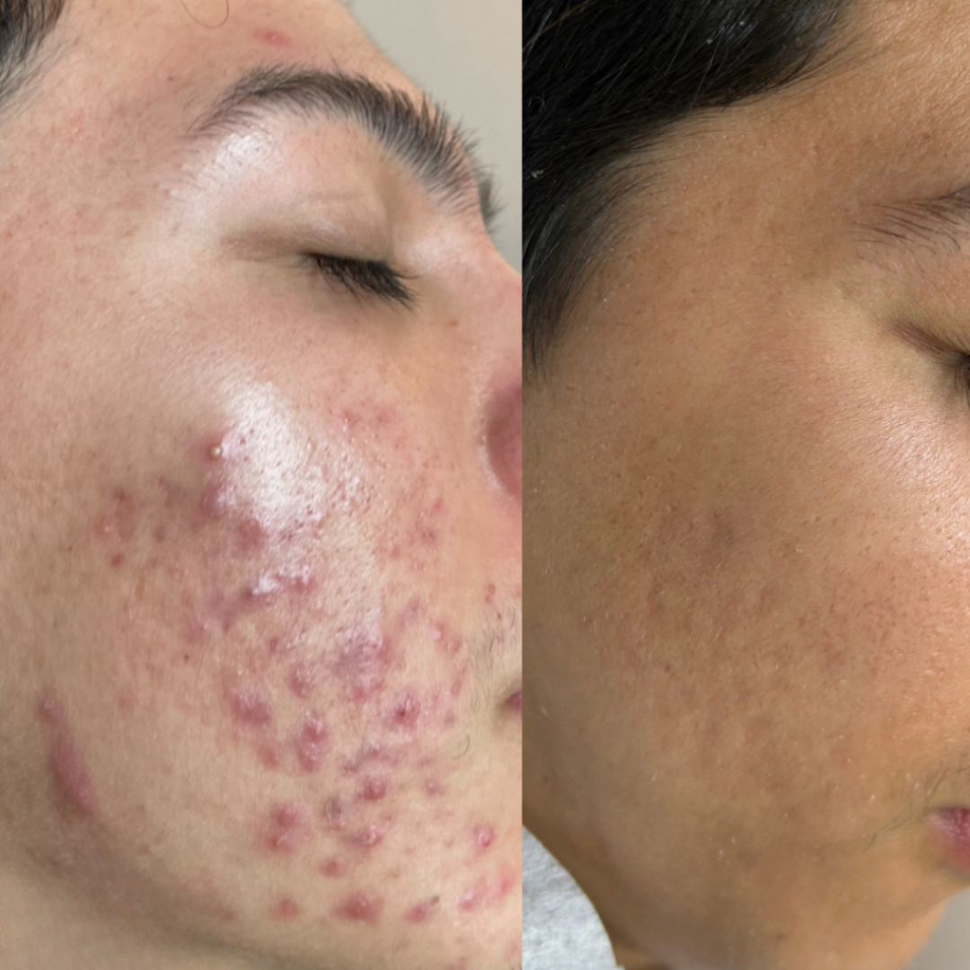 Sensitive Spot Cream