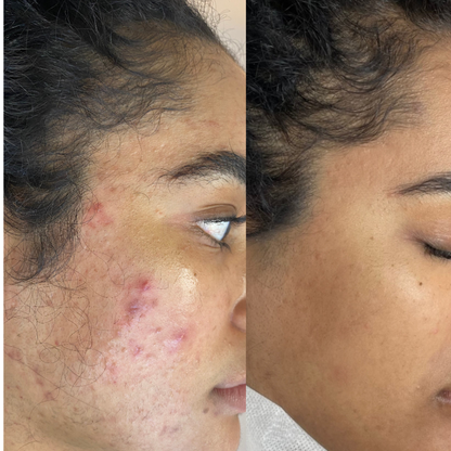 Sensitive Spot Cream